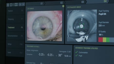 ophthalmic surgery. view on the screen of medical monitor in operating room. lasik