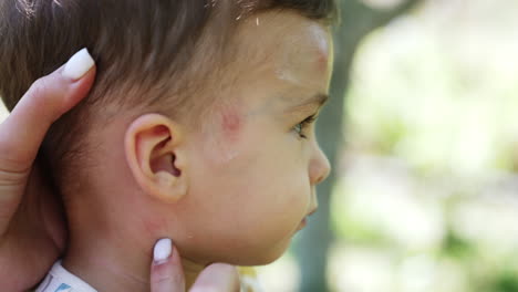 mother is holding her baby son by the head. caring mom puts some ointment on the spots from mosquito bites. close up.