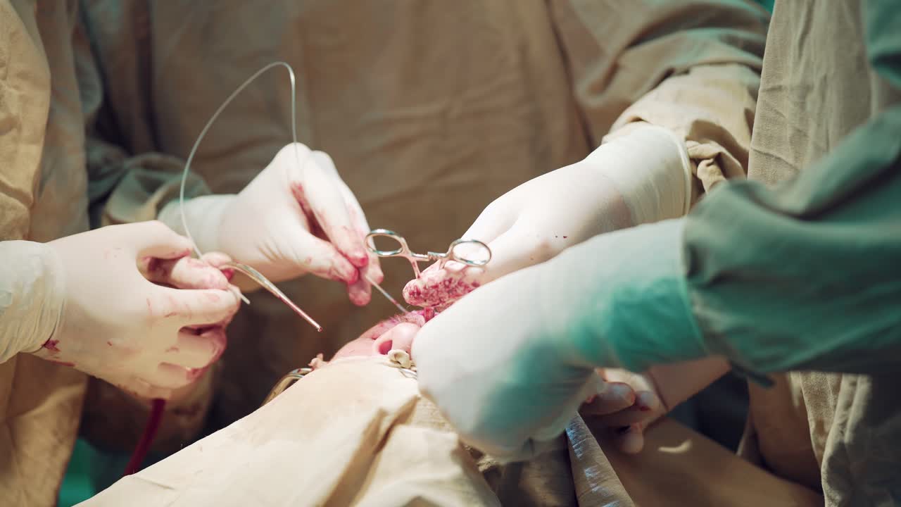 Three surgeons at work operating in surgical theatre. Resuscitation medicine team wearing protective masks saving patient. Surgery and emergency concept