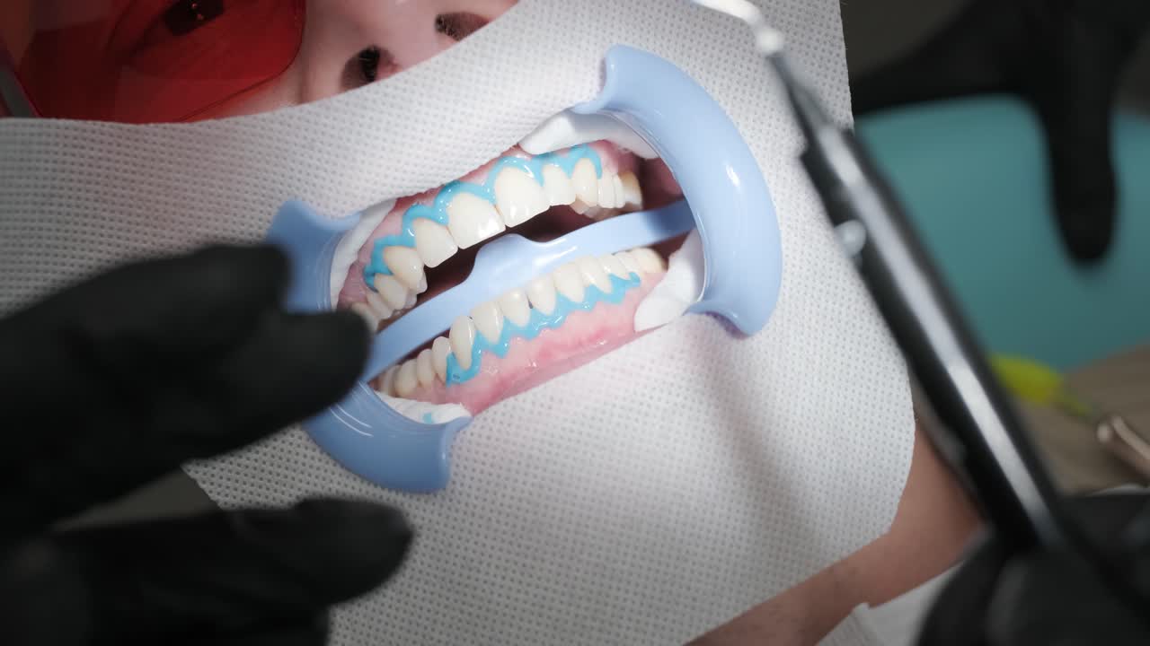 Teeth whitening procedure. Tooth whitening gel. Dentist does the whitening procedure