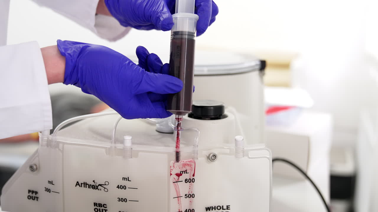 Big syringe filled with blood is attached to the centrifuge machine. Plasma extraction process.