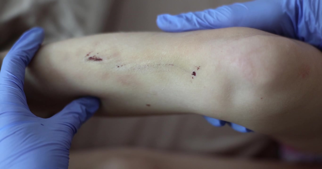Medico esamina con grande cura una ferita sulla gamba di un paziente.