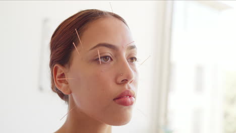 young woman with acupuncture needles in her head