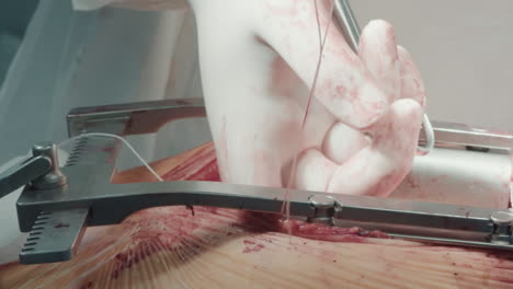 surgeon grafts vessels onto arteries. medic conducts operation creating new pathway for blood flow. process of coronary artery bypass graft surgery