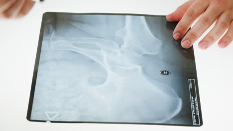 close-up of a medical professional examining a bone x-ray film with a pen