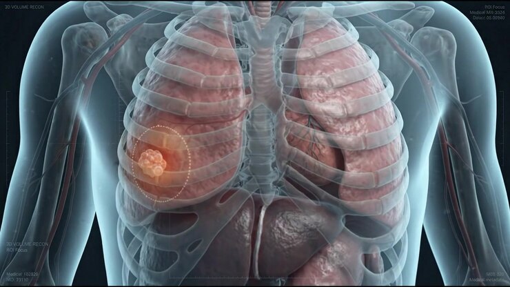 3D Medical Visualization of Lung Tumor in Human Chest