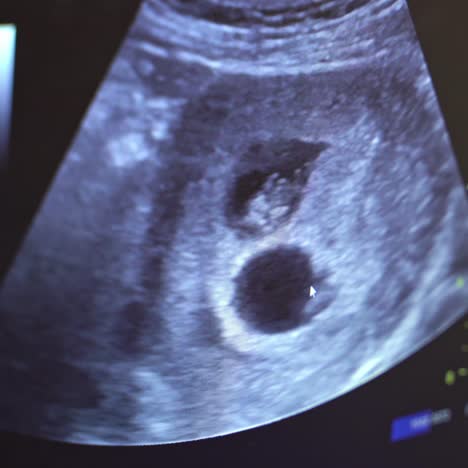 sonography. the screen of the ultrasound machine. results of the ultrasound on the monitor. health care concept