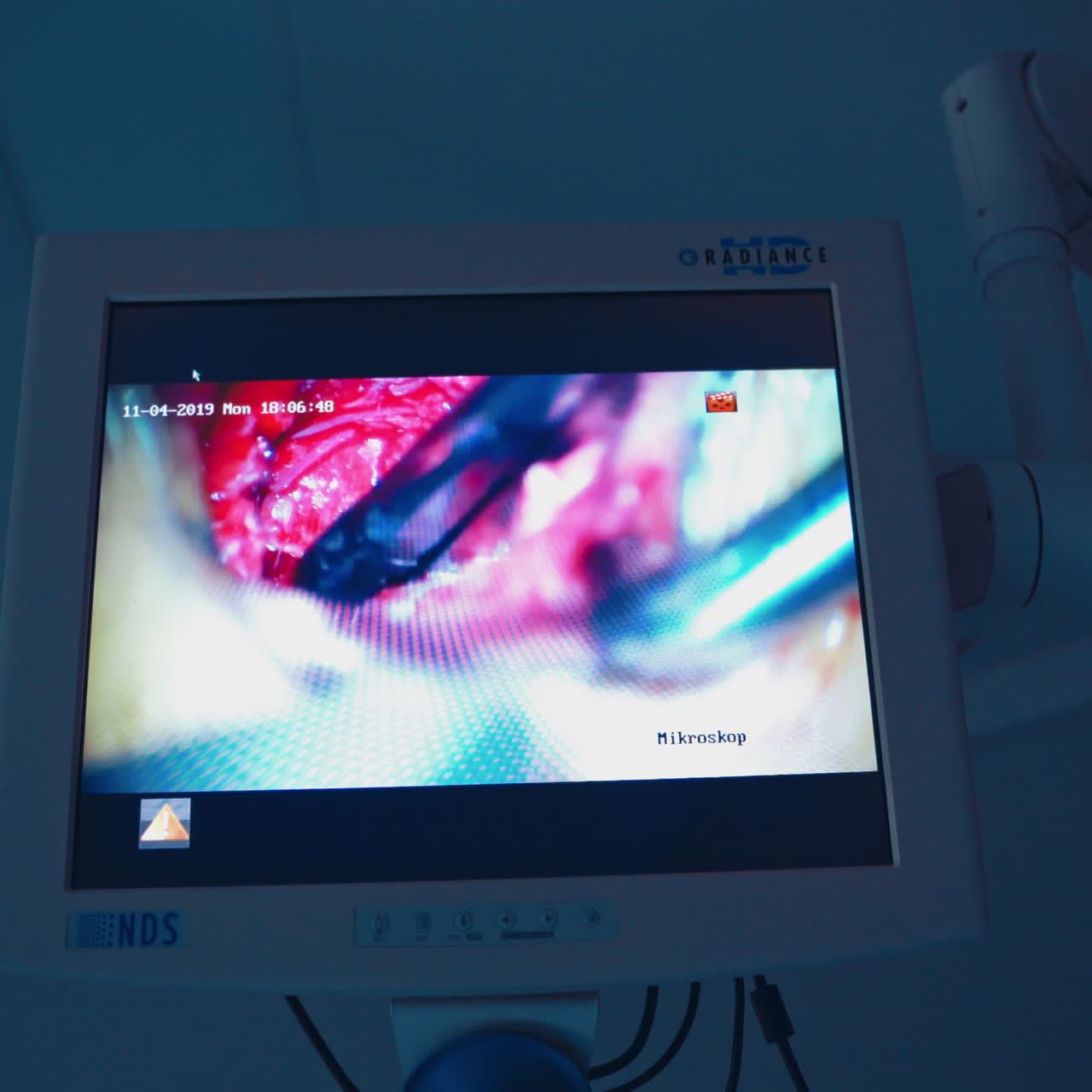 Process of endoscopic surgery on the screen. Surgery demonstrating on a display in the operating room.