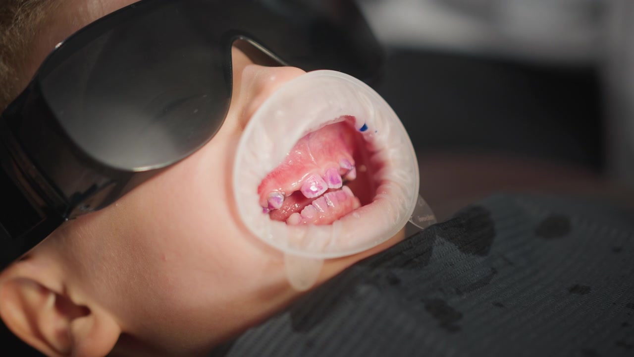 Primo piano di un bambino sdraiato con la bocca aperta che rivela lavori dentali e apparecchi ortodontici durante una procedura ortodontica. La scena mostra primi piani dettagliati che si concentrano sui denti del bambino sotto una luce soffusa