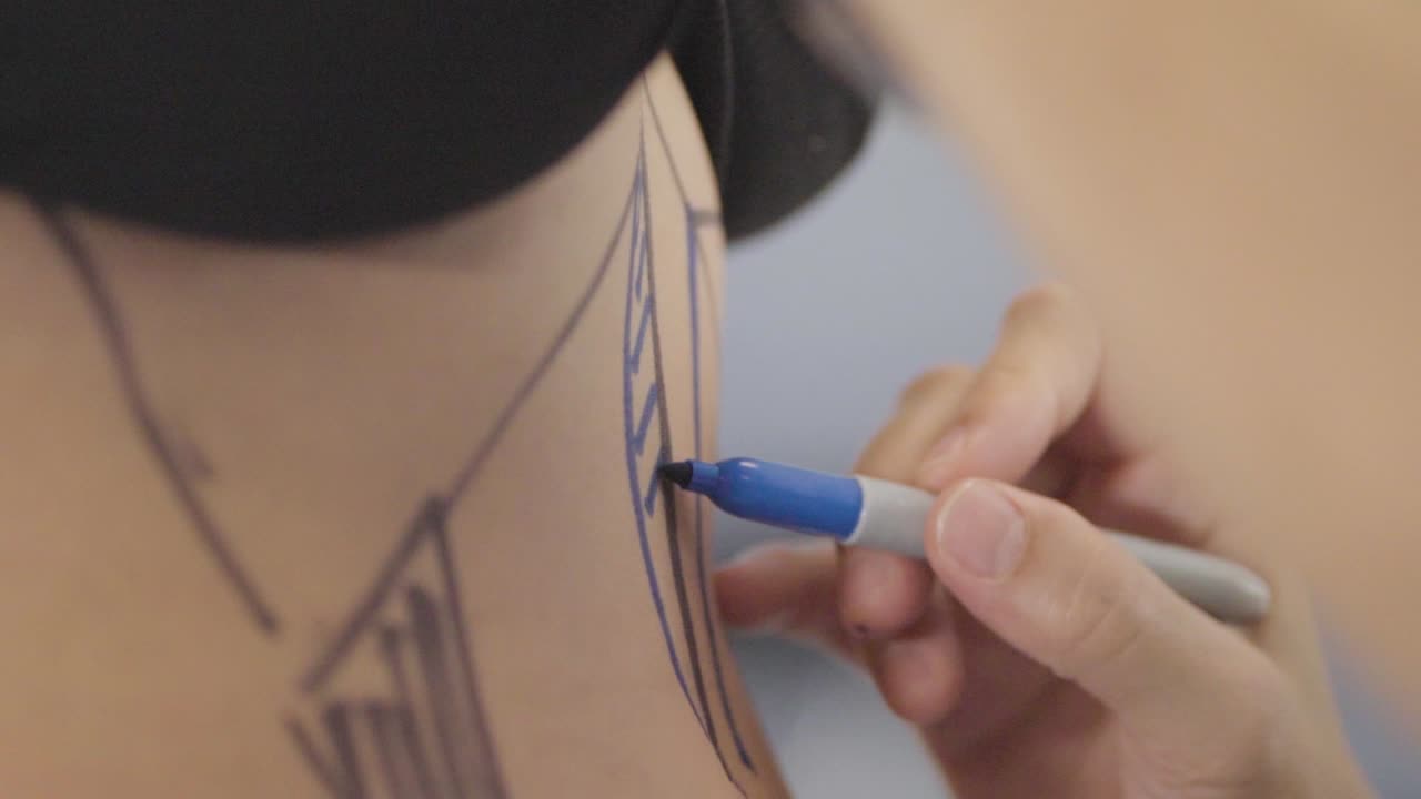 cirujano plástico marcando meticulosamente el abdomen de su paciente antes de la cirugía