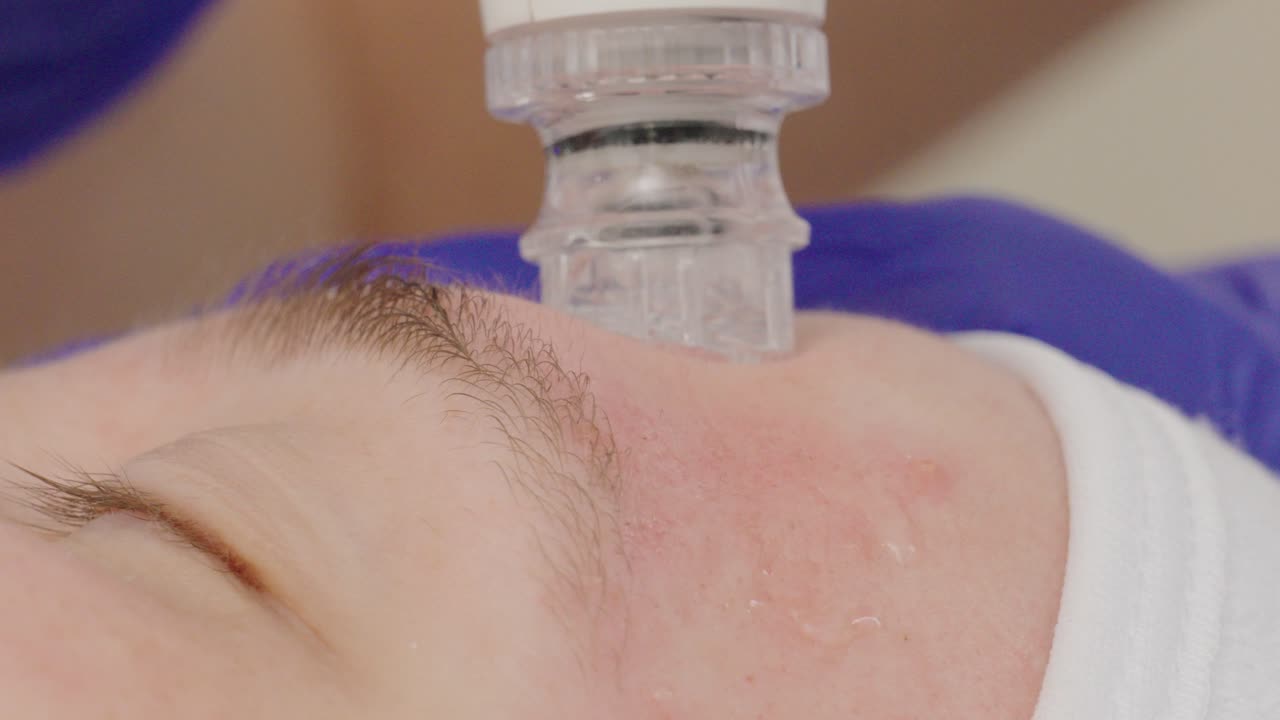 skin cleaning vacuum. Beauty treatment health centre. Skin cleaning machine.