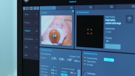 ophthalmic surgery. view on the screen of medical monitor in operating room. lasik