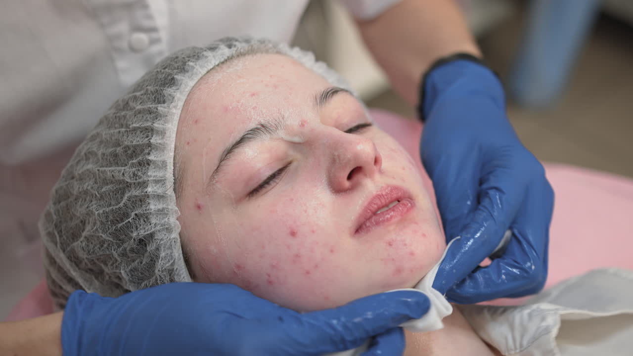 Facial Treatment for Acne