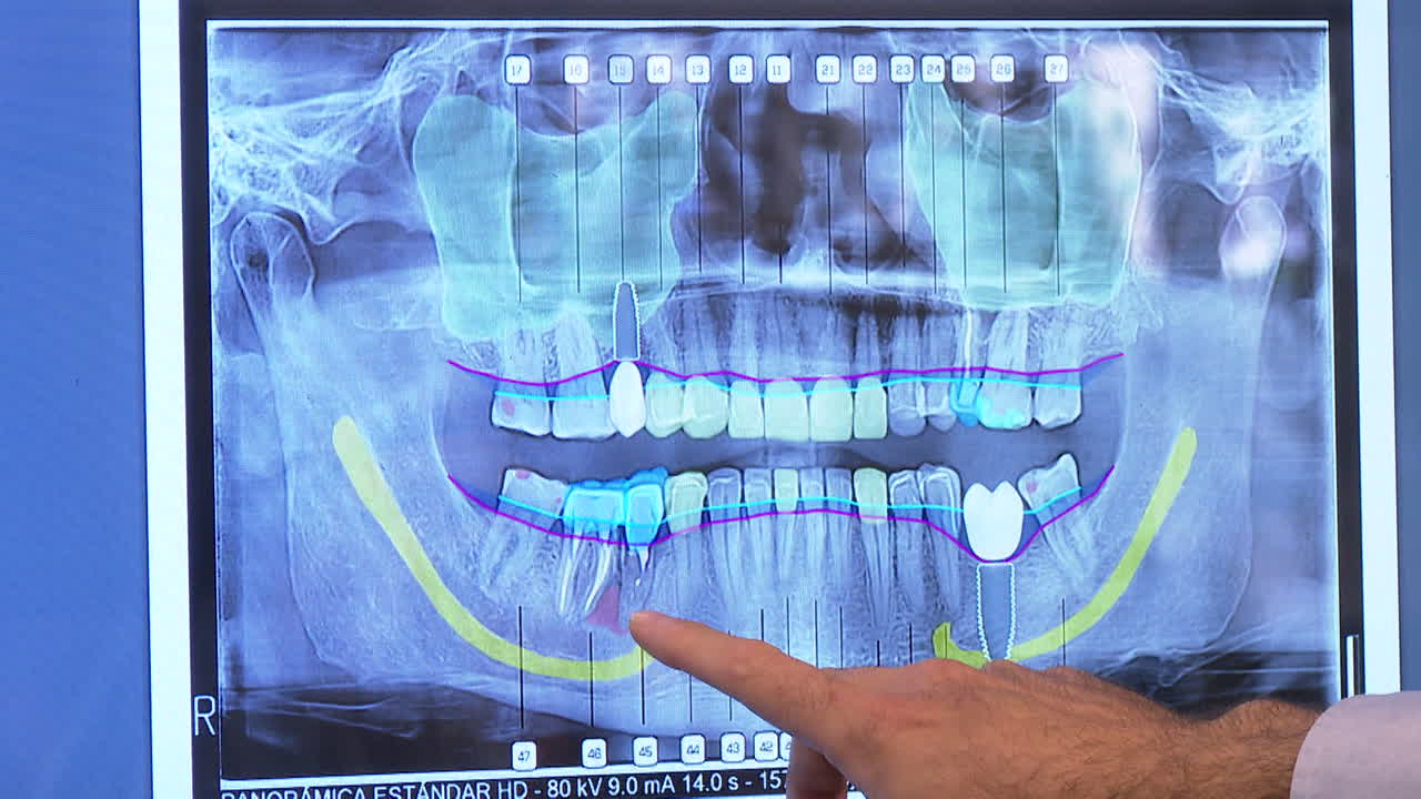 Dental Panoramic X-Ray Image