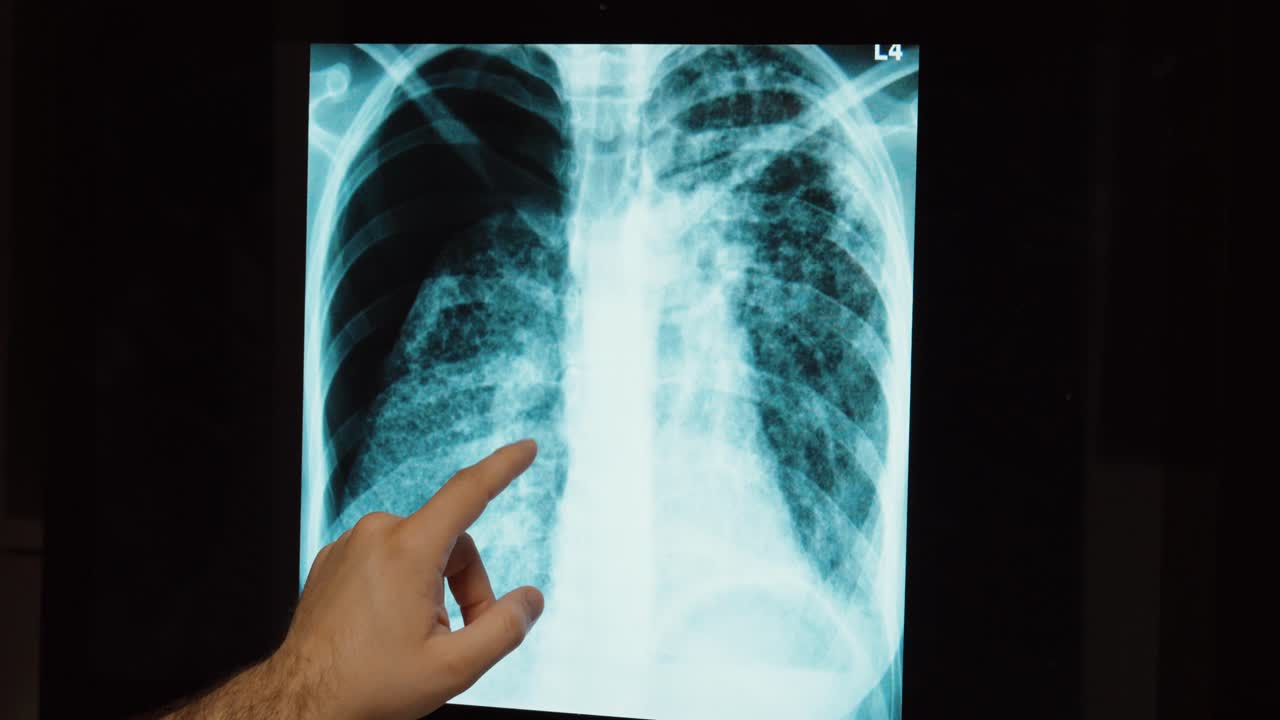 Close-up of a lung X-ray displayed on a medical screen while a hand points to the chest area. Concept of medical diagnosis, respiratory health, radiology, and lung disease examination