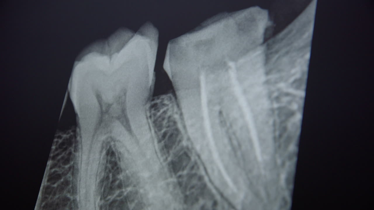 A dentist explains the root canal treatment from patients Xray scan