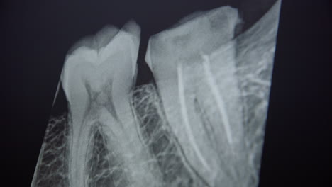 a dentist explains the root canal treatment from patients xray scan