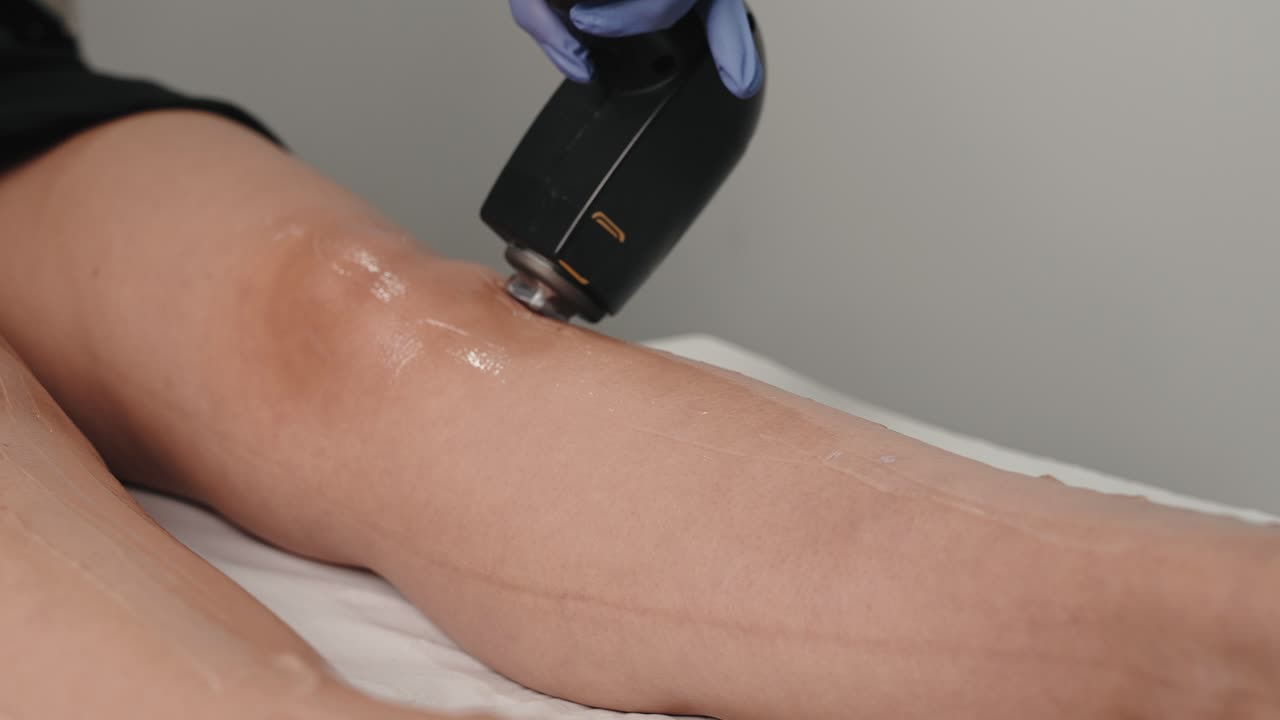 procedimiento de depilación láser en la parte inferior de las piernas, con el técnico aplicando el dispositivo láser sobre la piel cubierta de gel