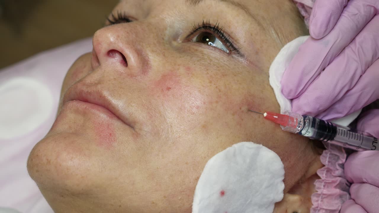 Cosmetic Procedure with Dermal Fillers