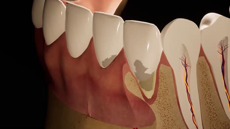 molar teeth damaged by caries. medically accurate tooth 3d animation