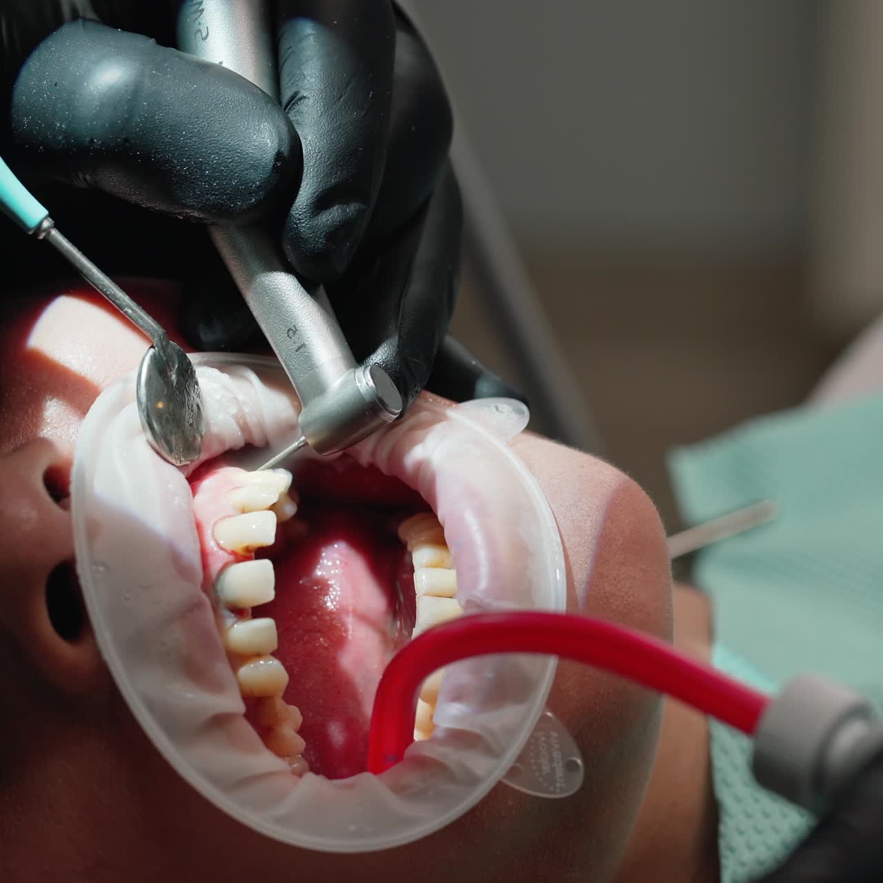 Tooth treatment. Female patient treating her tooth at the dentist's office. Hands of stomatologist working with dental tools in the woman's mouth. Close-up.