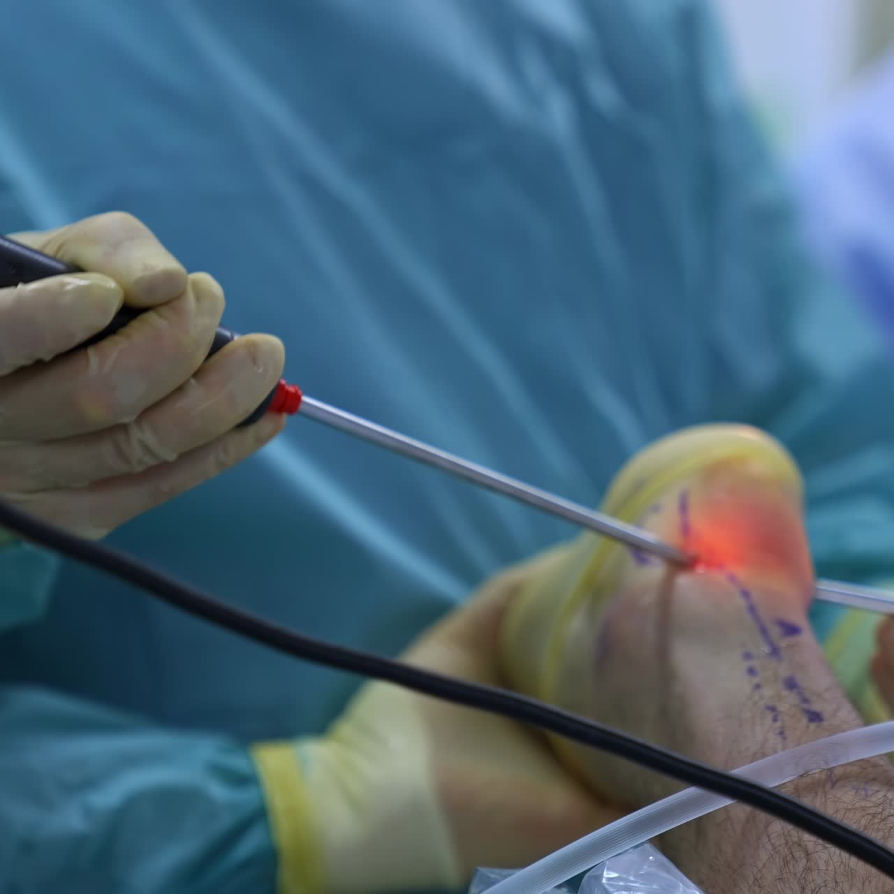 Surgeon holding laparoscopy instrument for operation