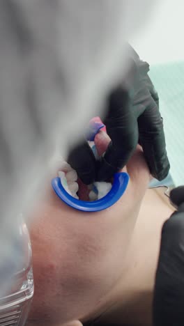 close-up of dentist removing gum protection gel on teeth whitening procedure