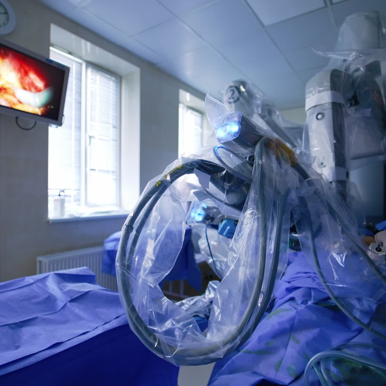 Gloved hand of a doctor holding a tool moves alongside with the robotic arm. Screen on the wall shows the procedure. Da Vinci robot operating the patient