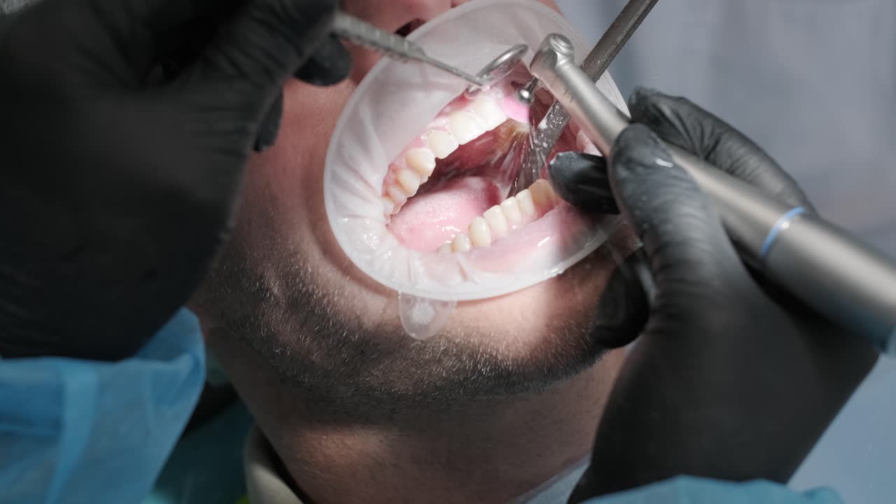 procedimiento de blanqueo de dientes. gel blanqueador de dientes. el dentista hace el procedimiento de blankeo