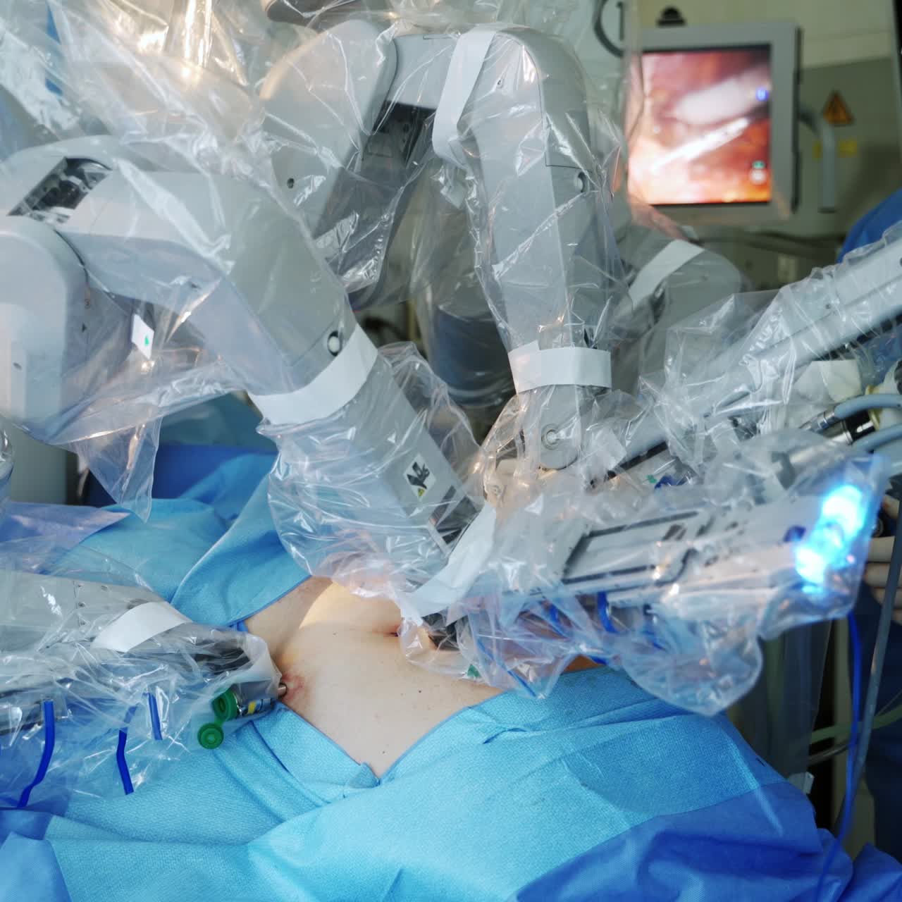 Futuristic surgery. Robotic arms of modern medical machine perform the operation on a patient in surgical room. New technologies in medicine.