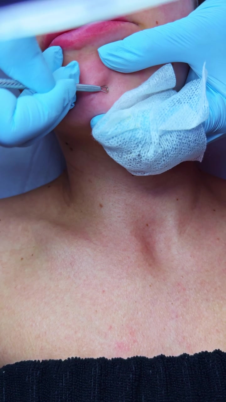 Donna che riceve un trattamento sulla pelle usando un ago in un ambiente clinico, con un professionista sanitario presente durante la procedura.