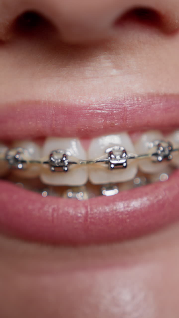 Close-up of Woman's Mouth with Braces