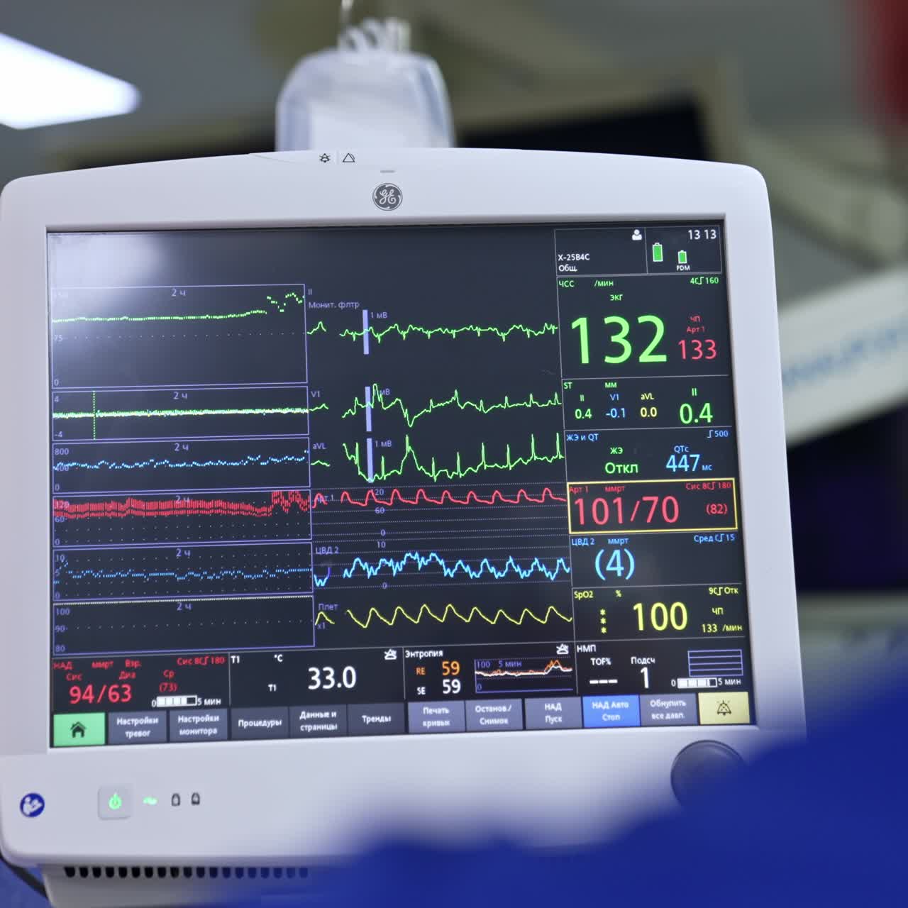 Lung ventilator monitor switched on. Screens with patient's life signs at operation process