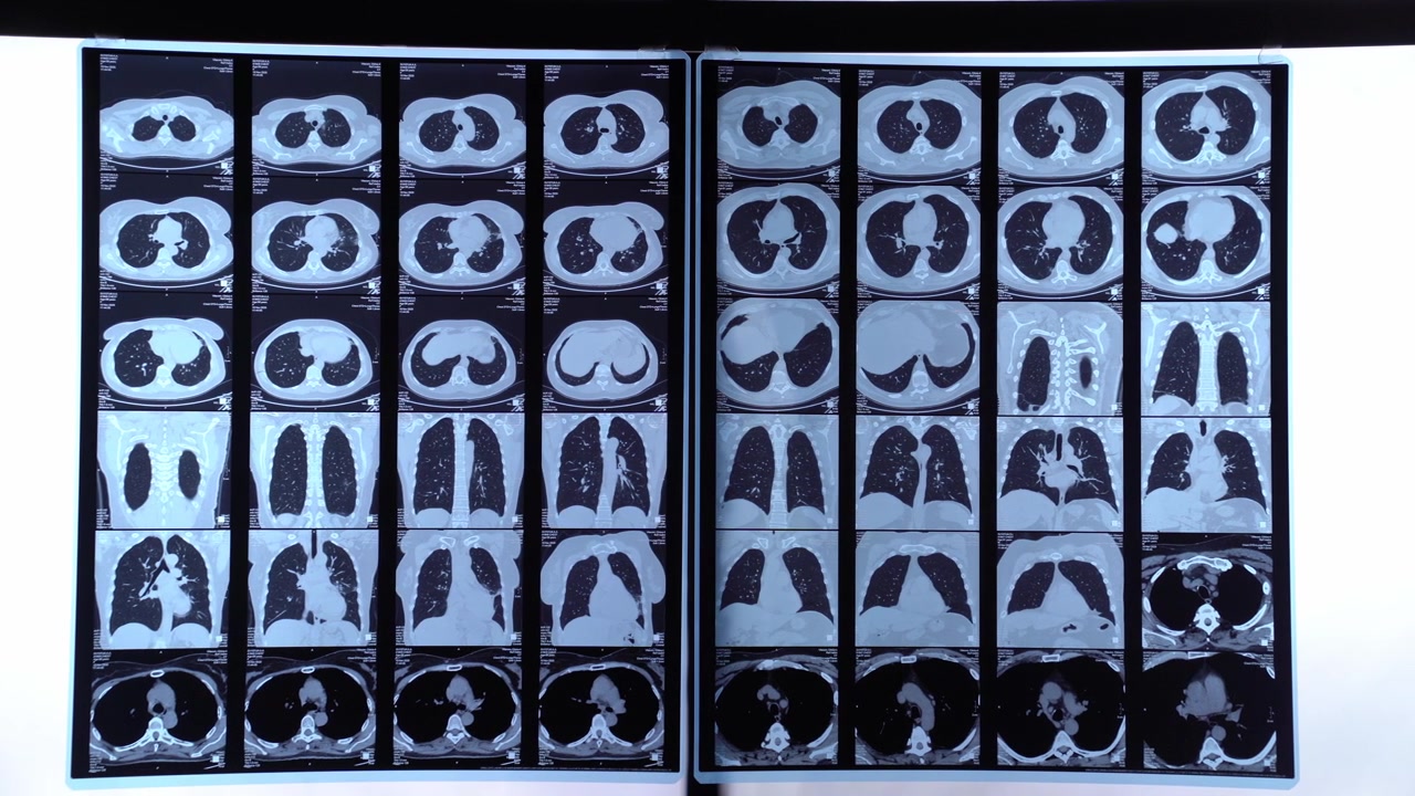 Diverse scansioni TC di polmoni e torace umani su display medico