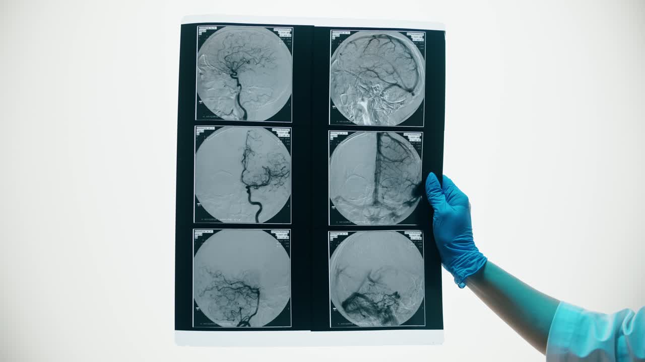 Professionista medico che tiene una pellicola di angiogramma cerebrale