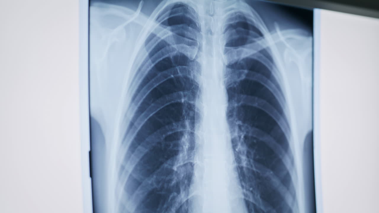 Radiografia toracica dettagliata che mostra i polmoni umani in primo piano. Pneumologo che esamina la scansione