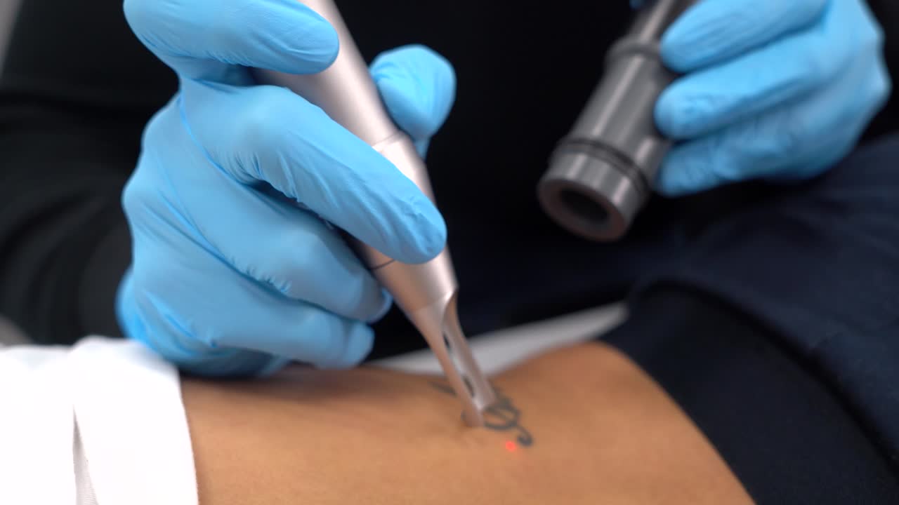 전 남자 친구 이름의 문신 지우기, 삭제 또는 제거