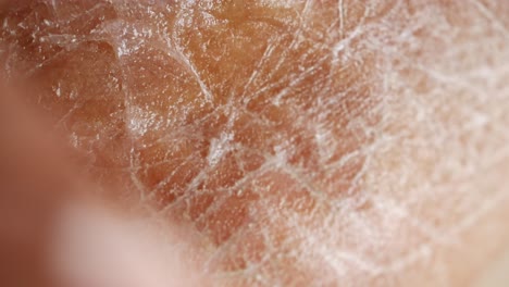 close-up of dry, cracked skin on a person's body