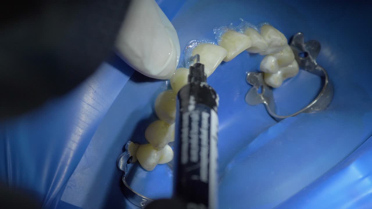 타르타르를 제거하기 위해 초음파를 사용합니다.