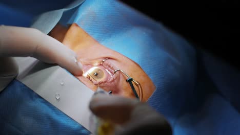 laser vision correction. a patient and team of surgeons in the operating room during ophthalmic surgery. eyelid speculum. lasik treatment. patient under sterile cover