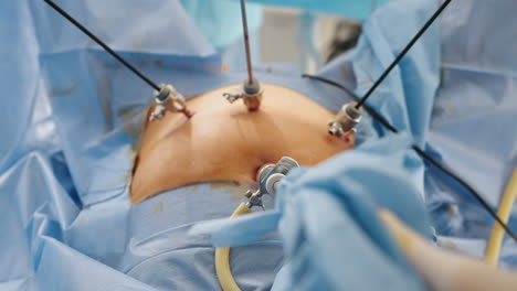 cirugía abdominal laparoscópica
