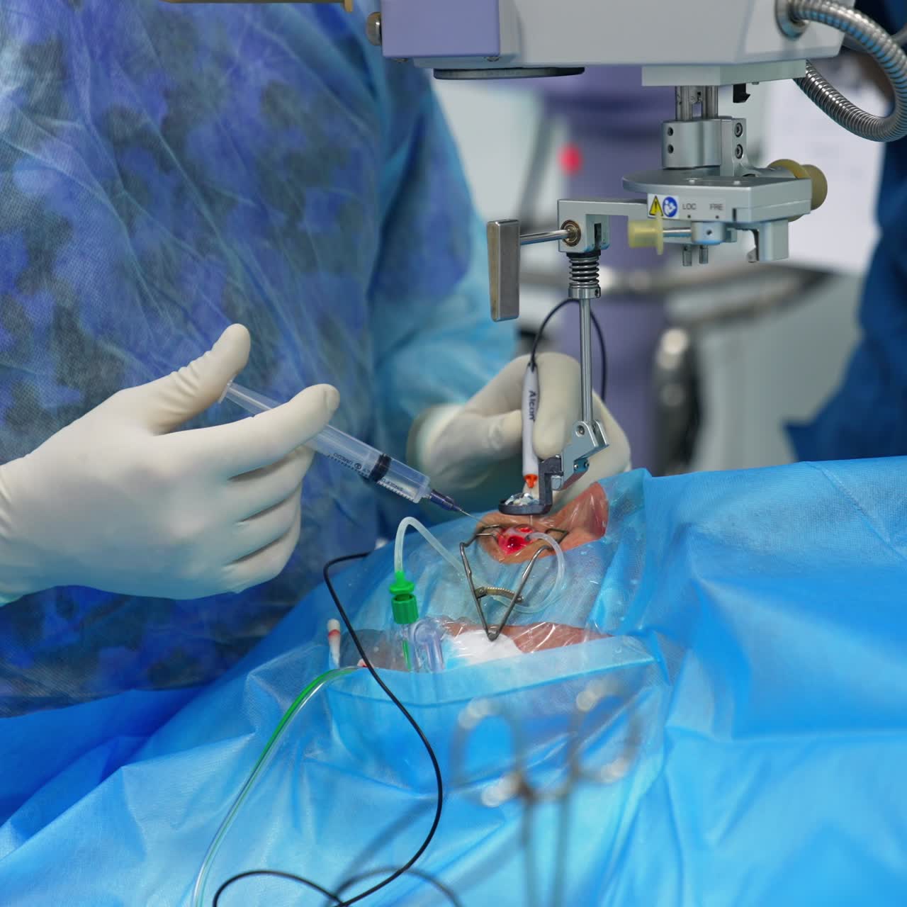 Surgeon's gloved hand holds the syringe inputting medicines into patient's eye. Doctor holding device tool in another hand