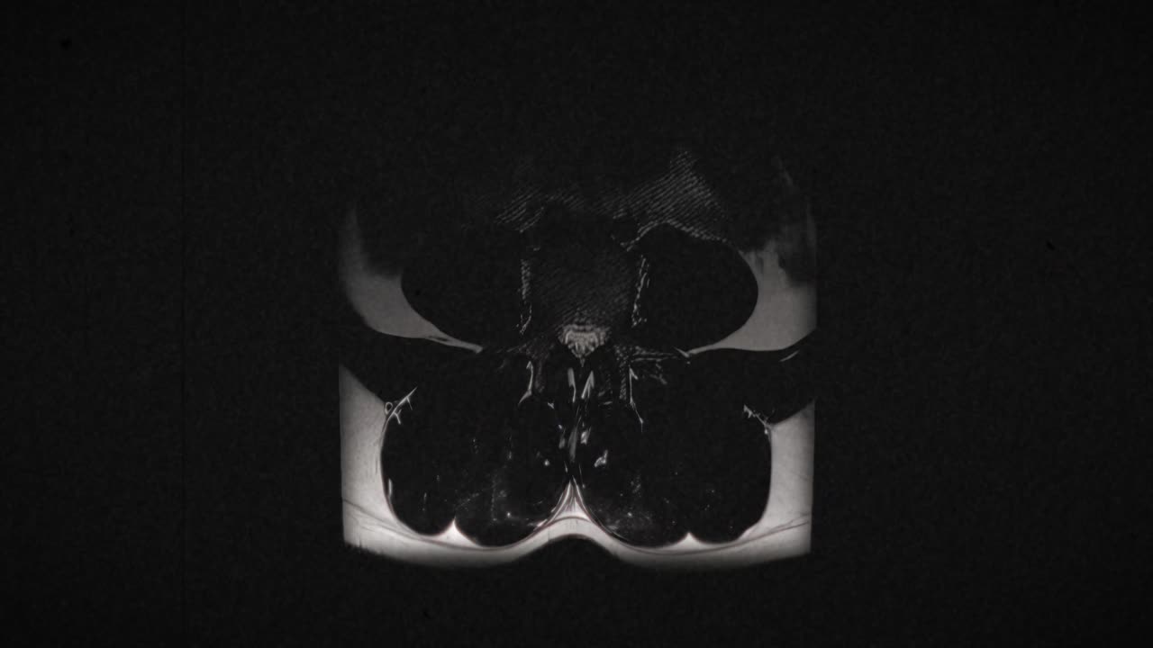 Grungy and highly textured vintage MRI scan of male lumbar spine with a herniated disc due to excess weightlifting training