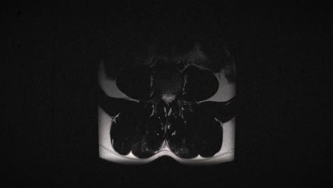 grungy and highly textured vintage mri scan of male lumbar spine with a herniated disc due to excess weightlifting training