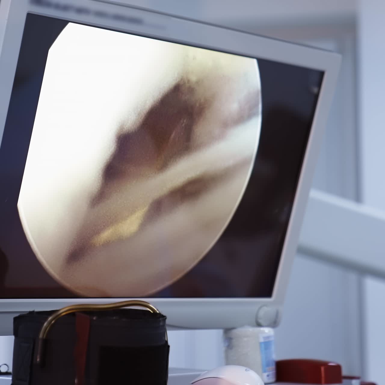 Surgical process on screen in the operating room. Medical monitor showing microsurgery with medical tool. Close-up