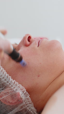 cosmetologist doing peeling procedure, woman skin regeneration, dermapen microneedling, dermastamp