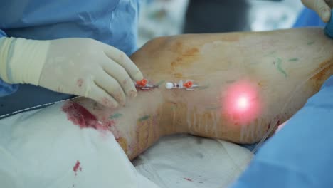 leg ulcer wound in treatment for varicose veins in phlebology procedure. bonding of veins using bioglue