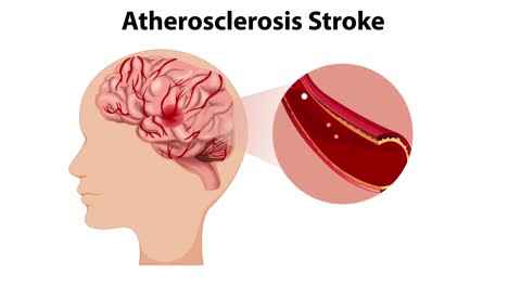 cholesterol plaque buildup leading to stroke