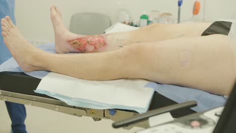 leg ulcer wound in treatment for varicose veins in phlebology procedure. bonding of veins using bioglue