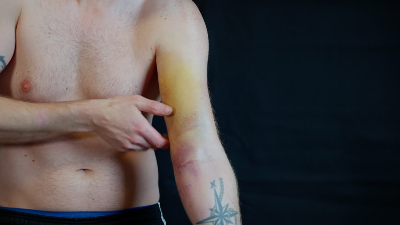 Man with ruptured biceps points out color change of bruise on upper arm one day after being injured.